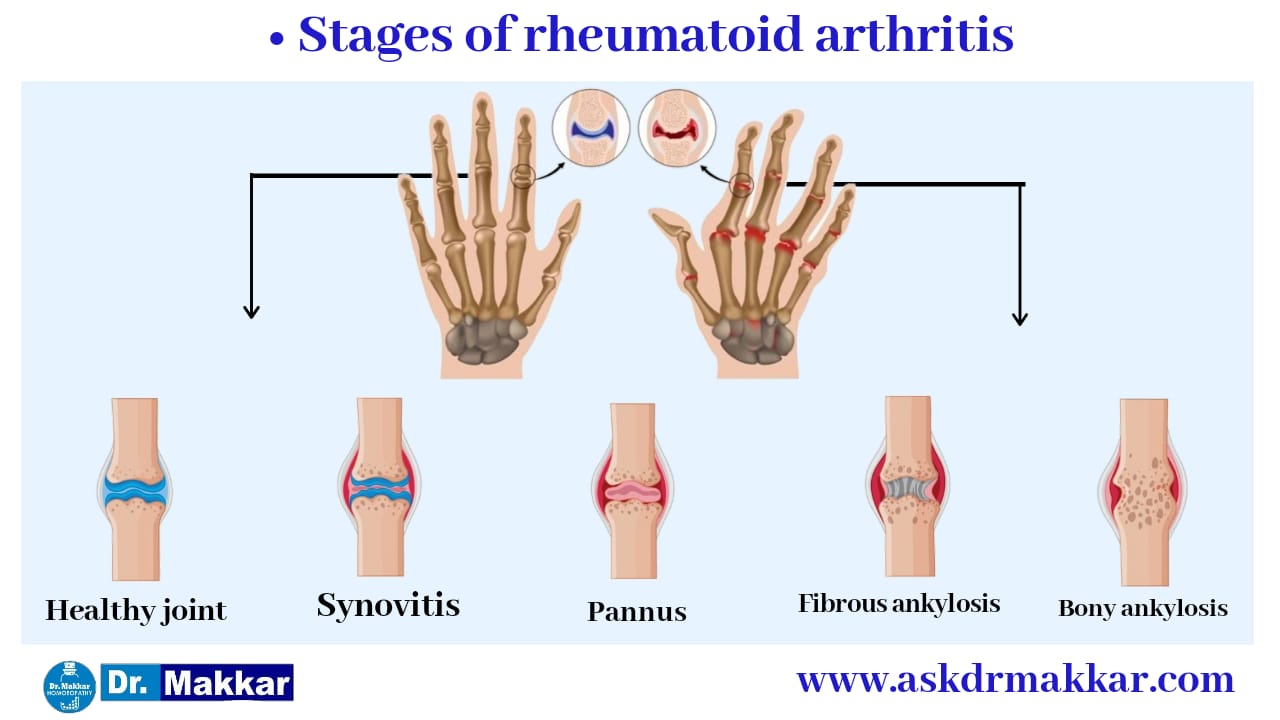 Rheumatoid Arthritis Stages And Progression Arthritis Treatment Hot Sex Picture 9795